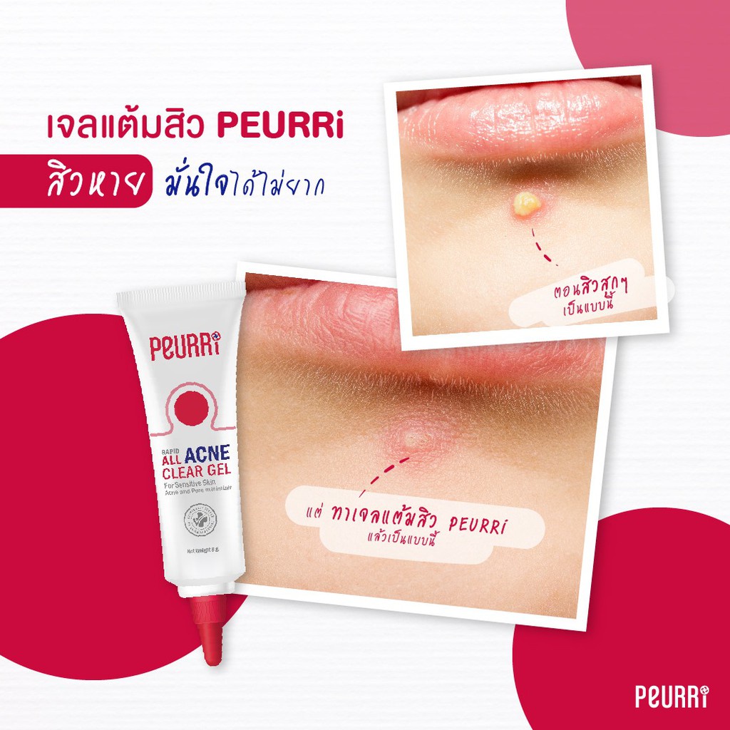 bonita-เจลแต้มสิว-เพียวรี-peurri-anti-acne-gel-เพียวรี-แอนตี้-แอคเน่-เจลลดสิวอักเสบ-สิวอุดตัน-สิวผด