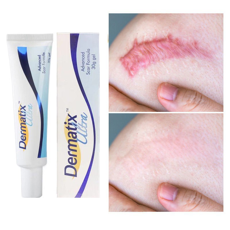 New Dermatix Ultra Scar Cream ครีมลดรอยแผลเป็น ลดรอยแผลเป็นจากสิว ลบรอยแผลเป็นจากสิว แผลเป็นจาก