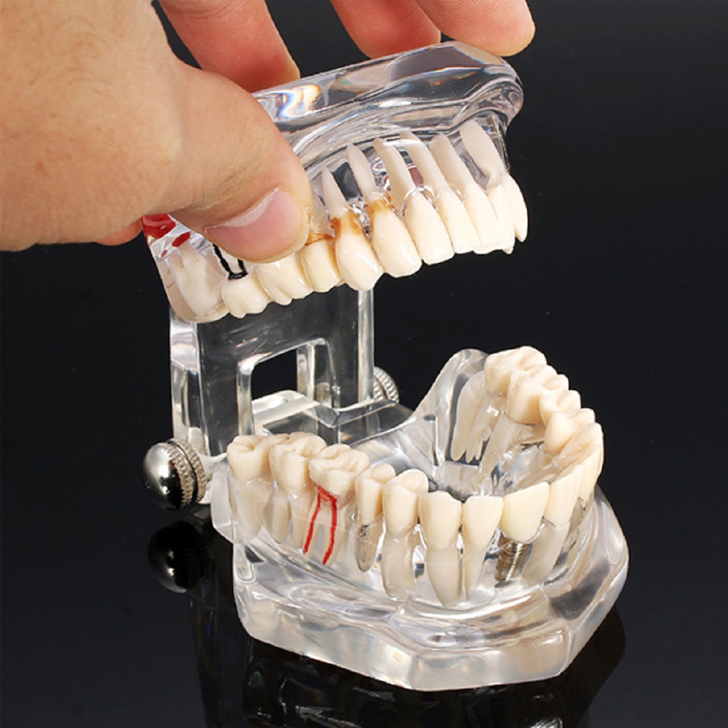 dental-implantation-model-study-teeth-bridge-disease-restoration-teaching-teaching