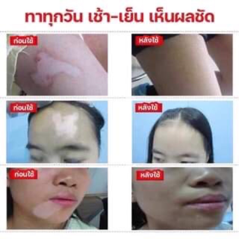 ผิวด่างขาวครีมสมุนไพรจีน-vitiligo-health-cream-ช่วยได้