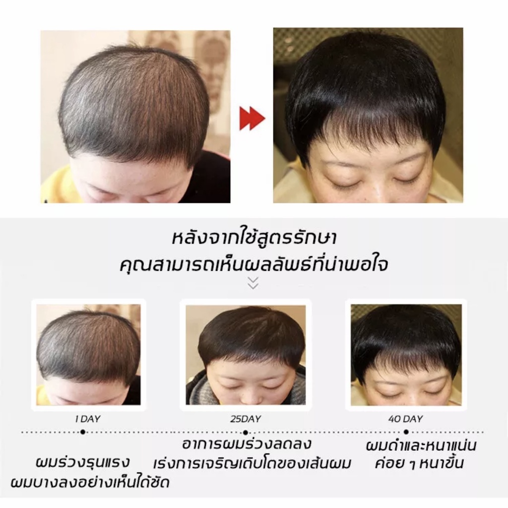 หมดปัญหาผมร่วง-น้ำยาปลูกผม-30ml-เร่งการงอกใหม่-ป้องกันไม่ให้ขิงหลุด-รากผมแข็งแรง-น้ำยาปลูกผมผู้ชาย-เซรั่มปลูกผม