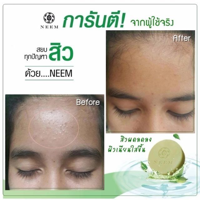 neem-bright-amp-clear-acne-soap-50g-สบู่นีม-สบู่สิวหลุด-บอกลาหน้าสิว-สู่หน้าใส