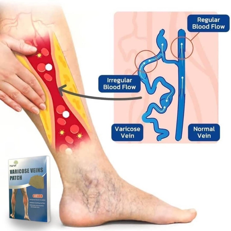 varicose-veins-patch-แผ่นแปะสมุนไพรแก้เส้นเลือดขอด