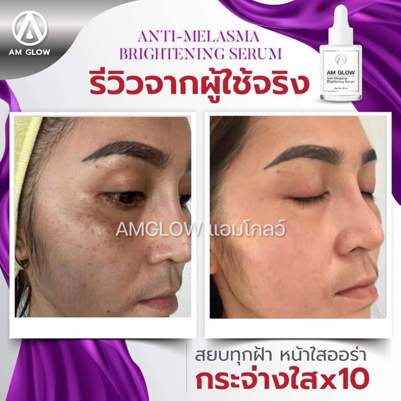 ส่งฟรี-เซรั่มฝ้า-am-glow-สลายฝ้าทุกประเภท-เห็นผลใน14วัน