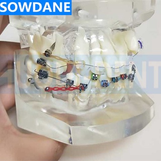 Transparent Dental Orthodontic Mallocclusion Model with Mental Ceramic Brackets Archwire buccal tube for Patient Communi