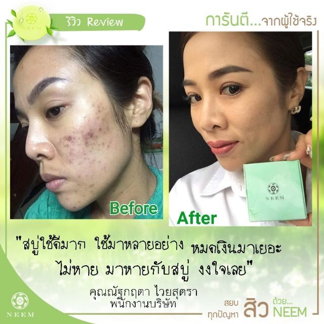 neem-bright-amp-clear-acne-soap-50g-สบู่นีม-สบู่สิวหลุด-บอกลาหน้าสิว-สู่หน้าใส