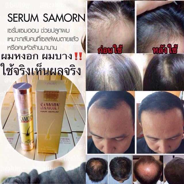 เซรั่มปลูกผมแซมออน-samorn-hair-serum-มีเก็บปลายทาง