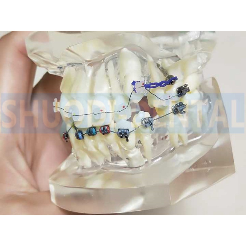 transparent-dental-orthodontic-mallocclusion-model-with-mental-ceramic-brackets-archwire-buccal-tube-for-patient-communi