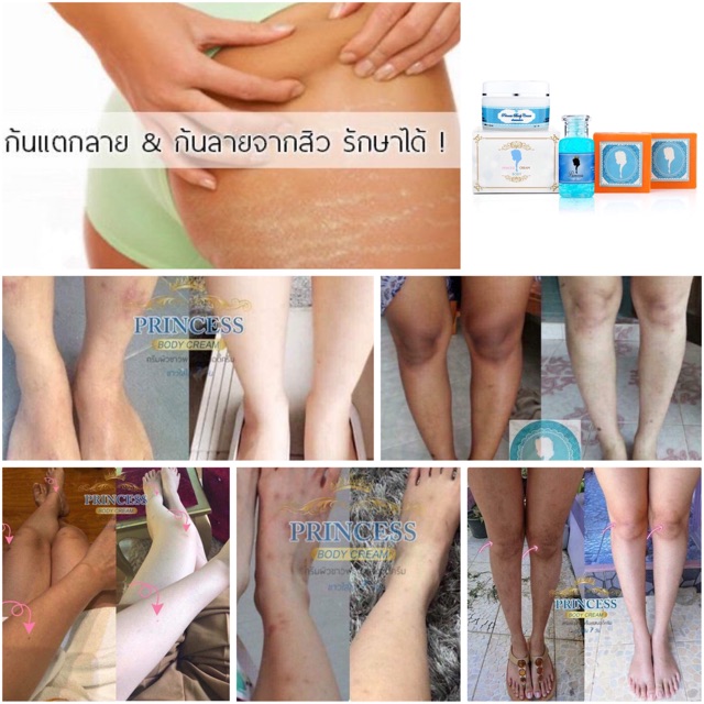 🍓ครีมแก้ขาลาย รอยยุงกัด ครีมผิวขาว ขาลาย น้ำเหลืองไม่ดี รักษาขาลาย  รอยดำจากรอยยุงกัด แก้ขาลาย วิธีรักษาขาลาย ลดรอยแตกลาย | Shopee Thailand