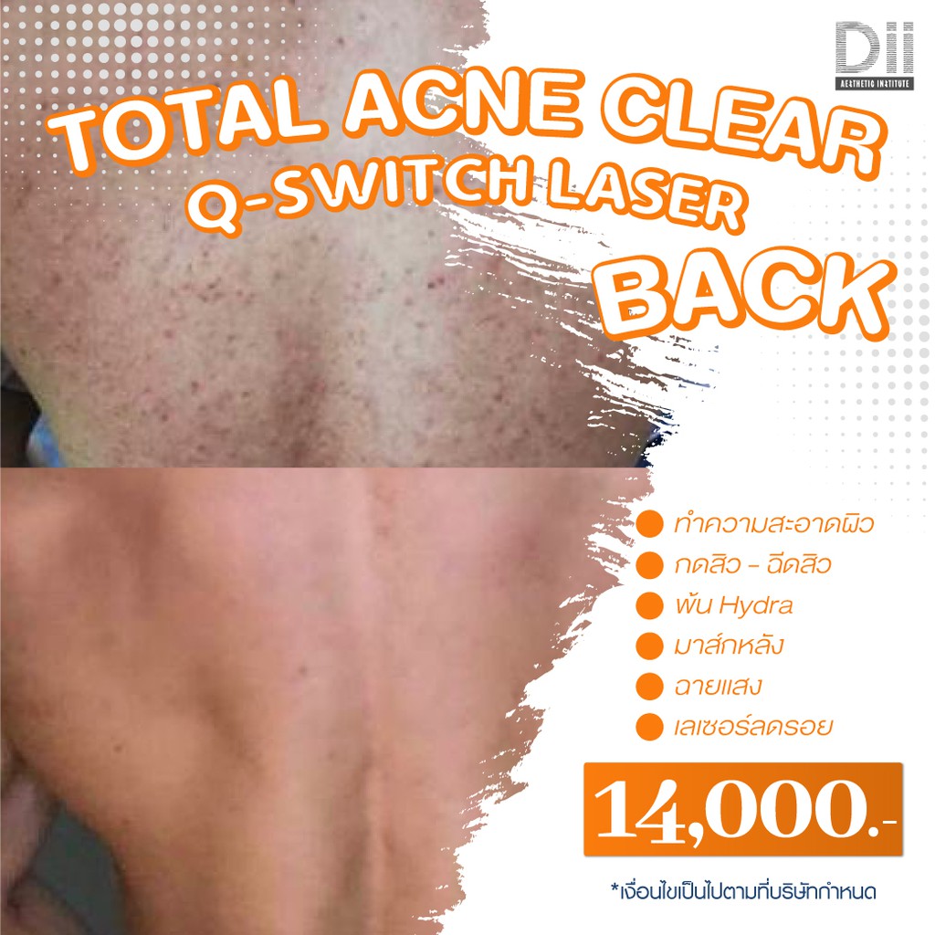 dii-aesthetic-total-acne-clear-q-switch-laser-back-1-time