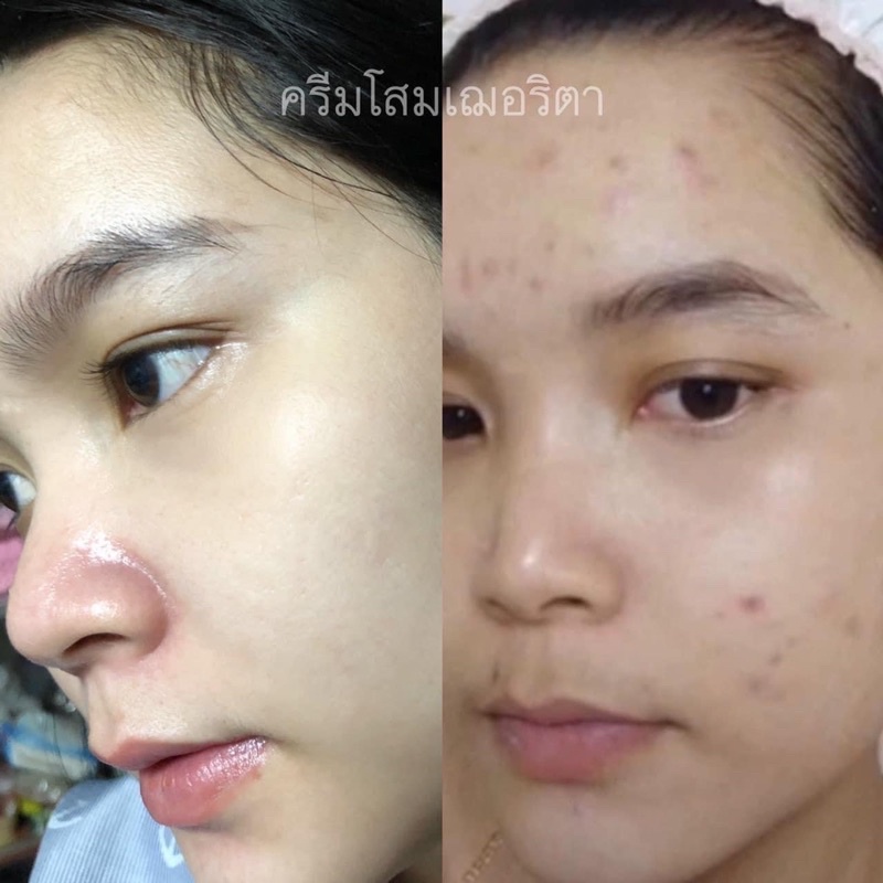 โสมเฌอริตา-ของแท้100-ลดสิว-ลดรอย-หน้าขาวใส-เห็นผลตั้งแต่กระปุกแรก