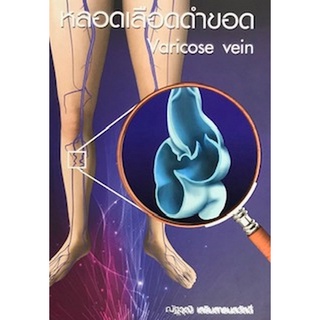 (ศูนย์หนังสือจุฬาฯ) หลอดเลือดดำขอด (VARICOSE VEIN) (9786164434028)