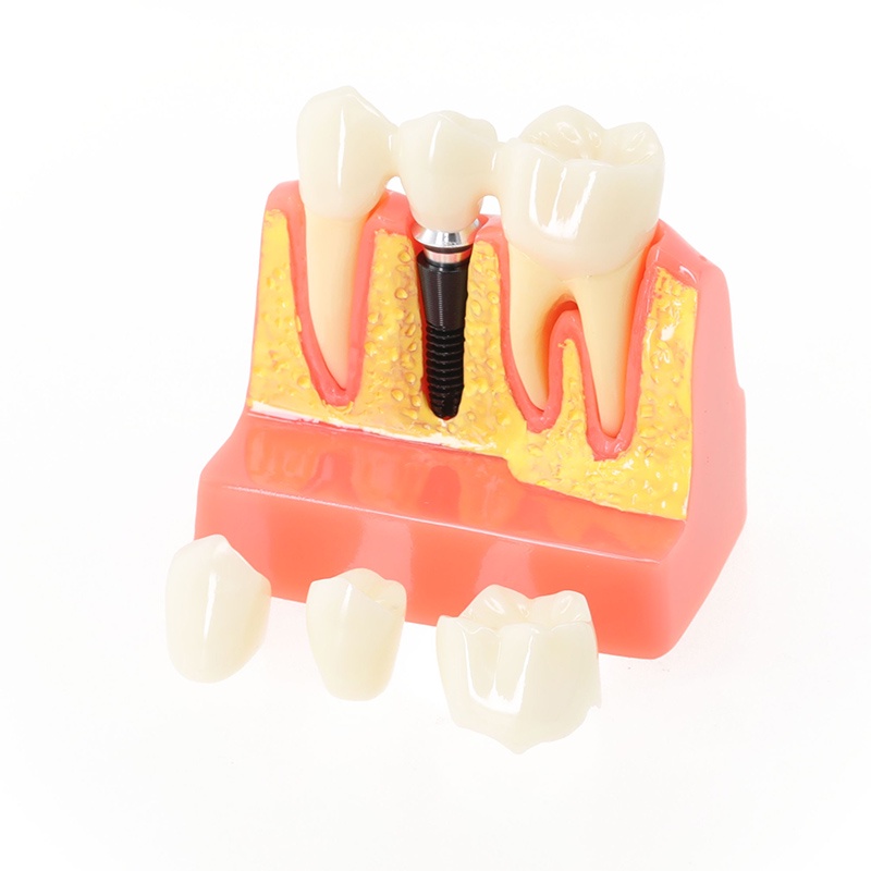โมเดลมงกุฎวิเคราะห์ฟัน-4-เท่า-สําหรับทันตกรรม