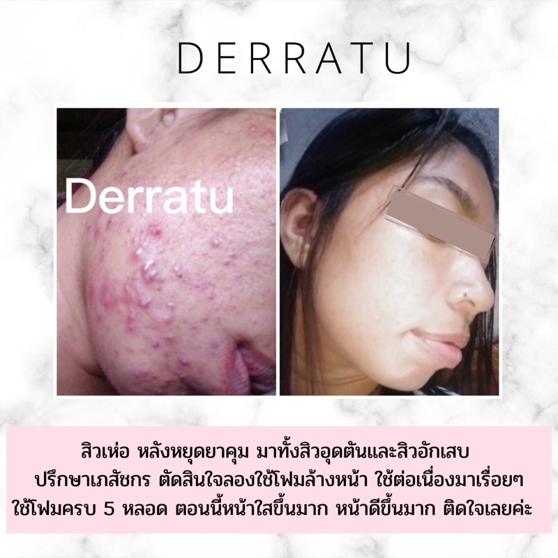 โฟมล้างหน้า-derratu-90g-2-ชิ้น-ลดสิวอุดตัน-ลดสิวหน้าใส-ลดมัน-ลดแผลสิว-หลุมสิวตื้น-รูขุมขนกระชับ