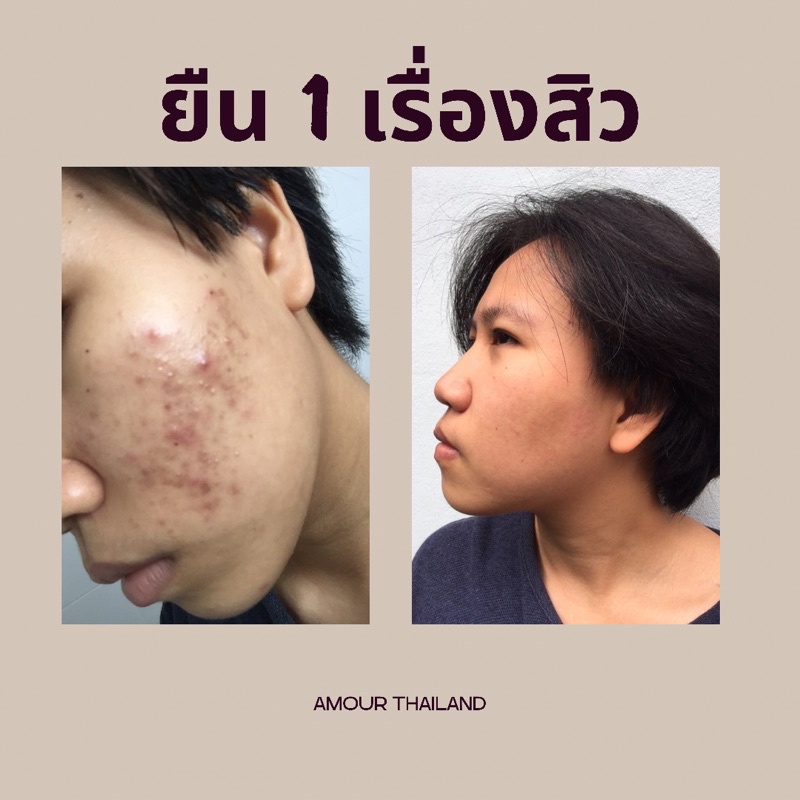 remove-mask-soap-สบู่สำหรับรักษาสิว-โดยตรง-ช่วยให้รูขุมขนกระชับ