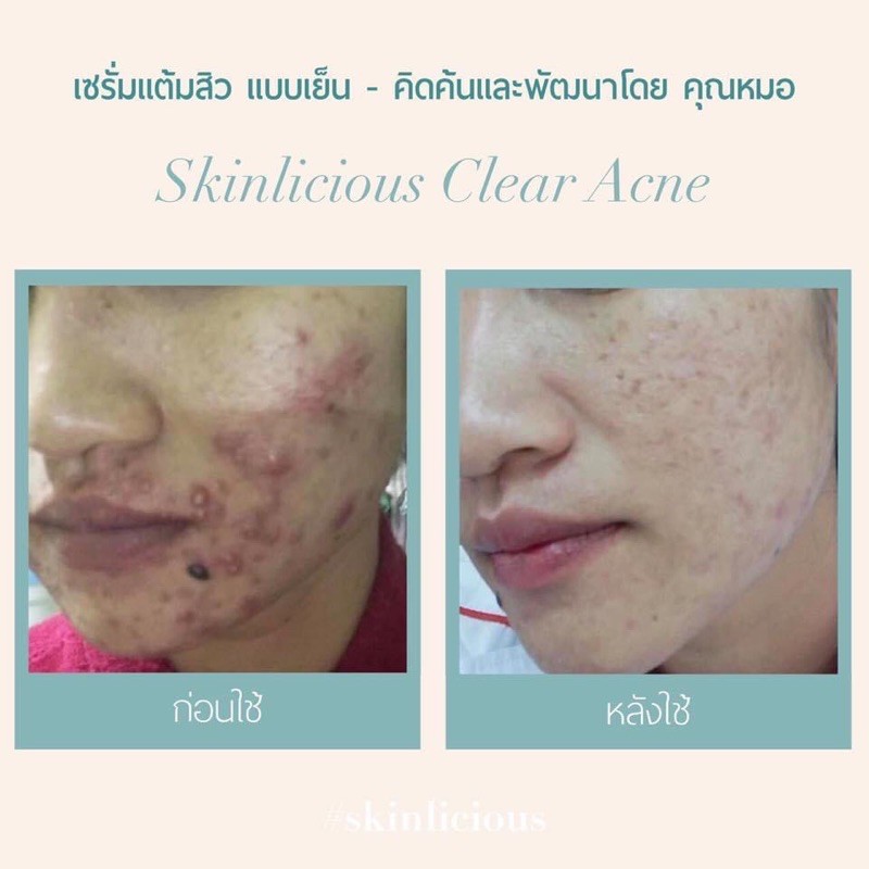 ที่แต้มสิว-skinlicious-หัวสิวแห้งไว-ลดการอักเสบ-ป้องกันการเกิดสิว