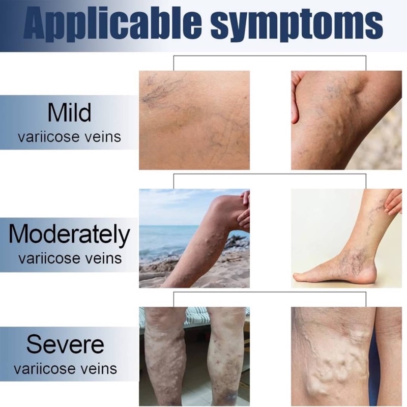 varicose-veins-patch-แผ่นแปะสมุนไพรแก้เส้นเลือดขอด