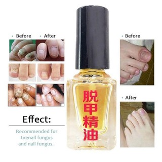 1 แถม 1 น้ำมันทาฆ่าเชื้อราเล็บ ขนาด 5 ml พร้อมส่ง