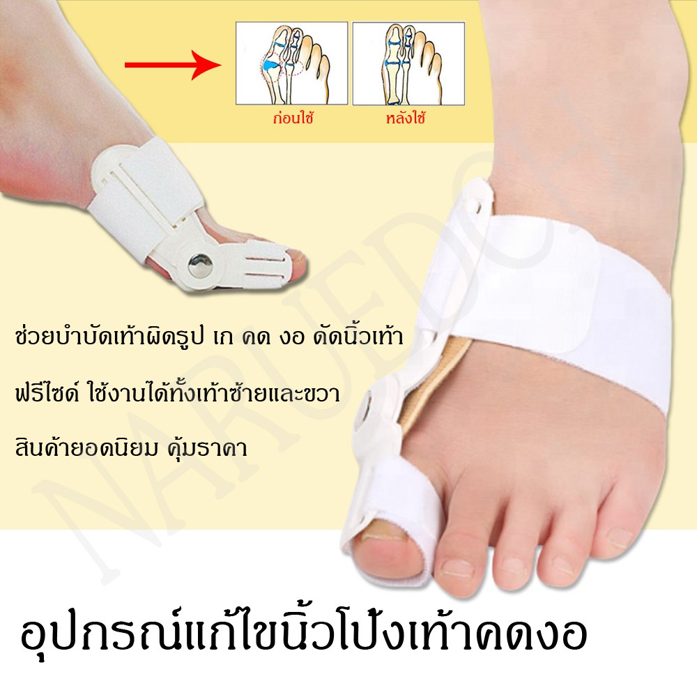 รูปภาพของเฝือกอ่อน อุปกรณ์แก้ไขเท้าผิดรูป (สำหรับผู้มีนิ้วโป้งเท้าเอียง) คดงอ ดัดเท้า เท้าเก เท้าเอียง ฟรีไซร์ พร้อมส่ง คุ้มราคาลองเช็คราคา