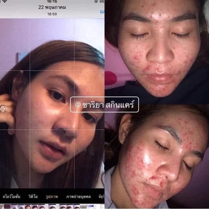 ของแท้ส่งฟรี-เซตผิวหน้าสวยใสไร้สิวฝ้ากระ-จุดด่างดำดูจางลง-ลดความหมองคล้ำบนใบหน้า-กันแดดปกป้องผิว-ผิวกระชับ-ชาริยา