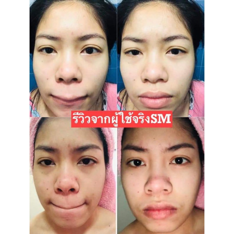 พร้อมส่ง-sm-skin-me-เซ็ตคู่-จบทุกปัญหาผิวหน้า