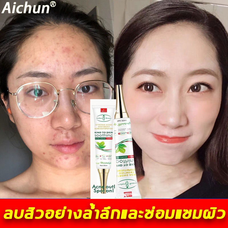 aichunครีมลบรอยดำสิว30mlรักษาสิวอย่างล้ำลึก-ซ่อมแซมรอยสิวและหลุมสิว-ครีมลดรอยสิว-ครีมแต้มสิว-เซรั่มกำจัดสิว-ครีมกำจัดสิว