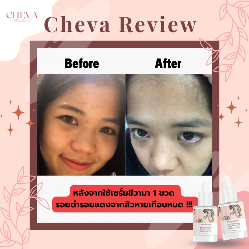 cheva-booster-serum-ชีวา-บูสเตอร์-เซรั่ม-เซรั่มหน้าใส-ป้องกันการเกิดสิว-ลดรอยสิว-กู้ผิวเด็ก-ด้วยสารสกัดจากธรรมชาติ-100