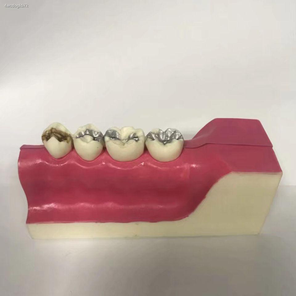 แบบจำลองฟันทันตกรรม-แบบจำลองการสลายตัวของเนื้อเยื่อฟันหลังล่างขวา
