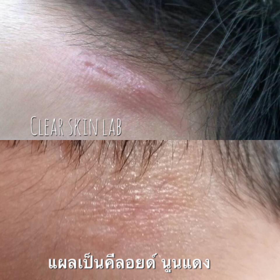 clear-skin-7-กรัม-ครีมรักษาแผลเป็นคีลอยด์สูตรเข้มข้น-มีรีวิว