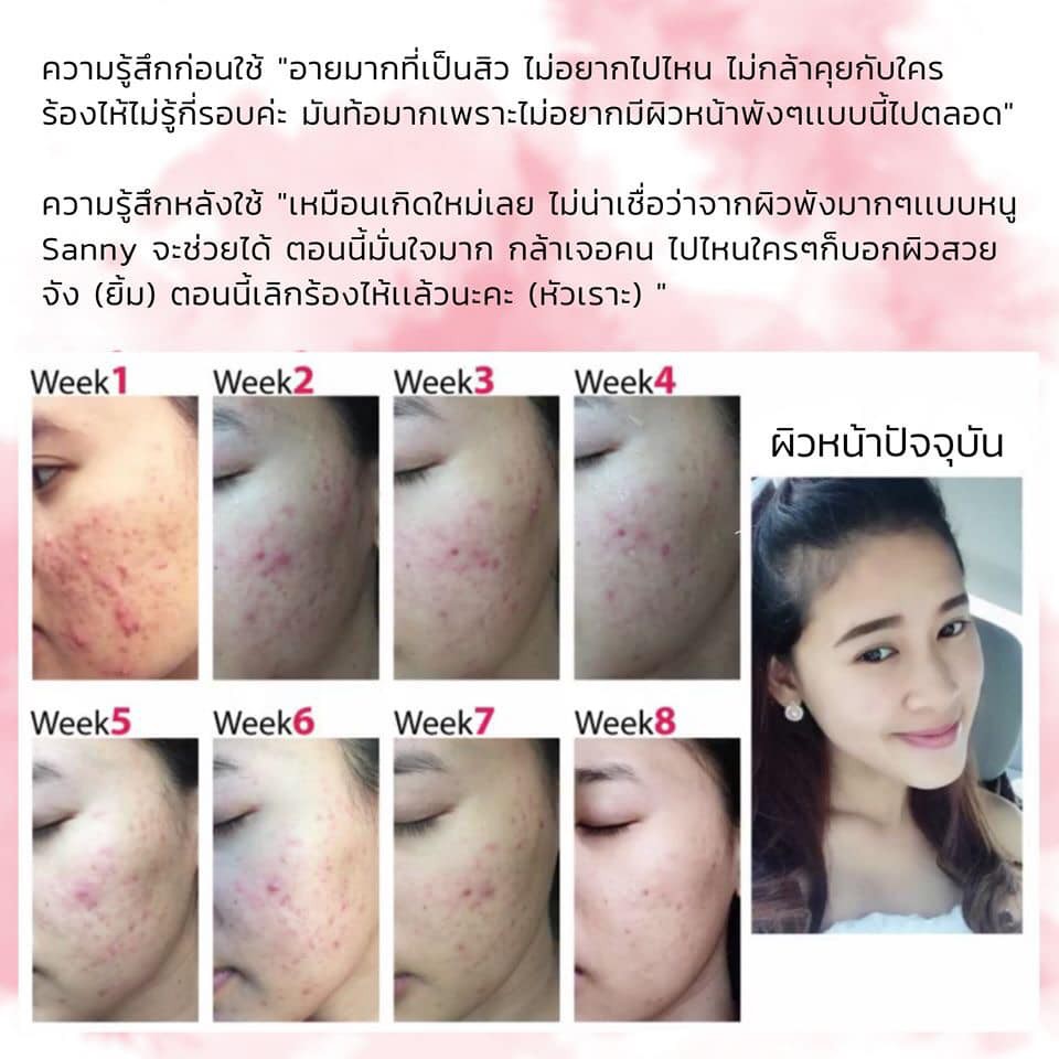 ขายดีมาก-เซ็ทสยบสิว-sanny-anti-acne-essence-แถม-ผงทานาคาผสมเปลือกมังคุด