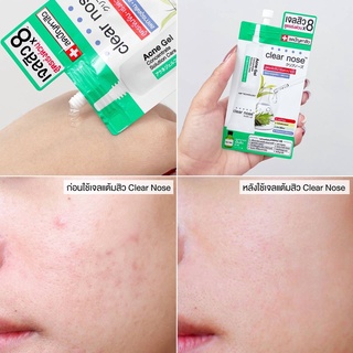 ภาพขนาดย่อของภาพหน้าปกสินค้า( กล่อง ) เขียว Clear nose Concentrate Solution Care เคลียร์โนส แอคเน่ เจล คอนเซนเทรท โซลูชั่น แคร์ เจลสิว 1 กล่อง 6 ซอง จากร้าน kaewbeautysurin บน Shopee ภาพที่ 2