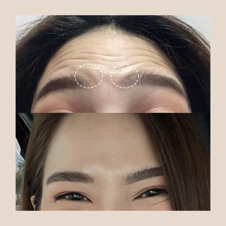 ภาพขนาดย่อของภาพหน้าปกสินค้าBotox (Aestox) Wrinkles โบท็อก ริ้วรอย จากร้าน mekobfillclinic บน Shopee ภาพที่ 8