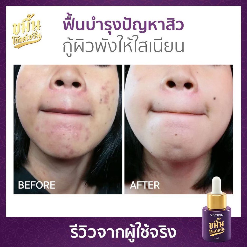 ขมิ้นโกลด์เซรั่ม-เซรั่มจุ๋ย-by-viv-skin-ให้คุณ-มั่นหน้าสด-ด้วยหยดขมิ้นทอง-สน