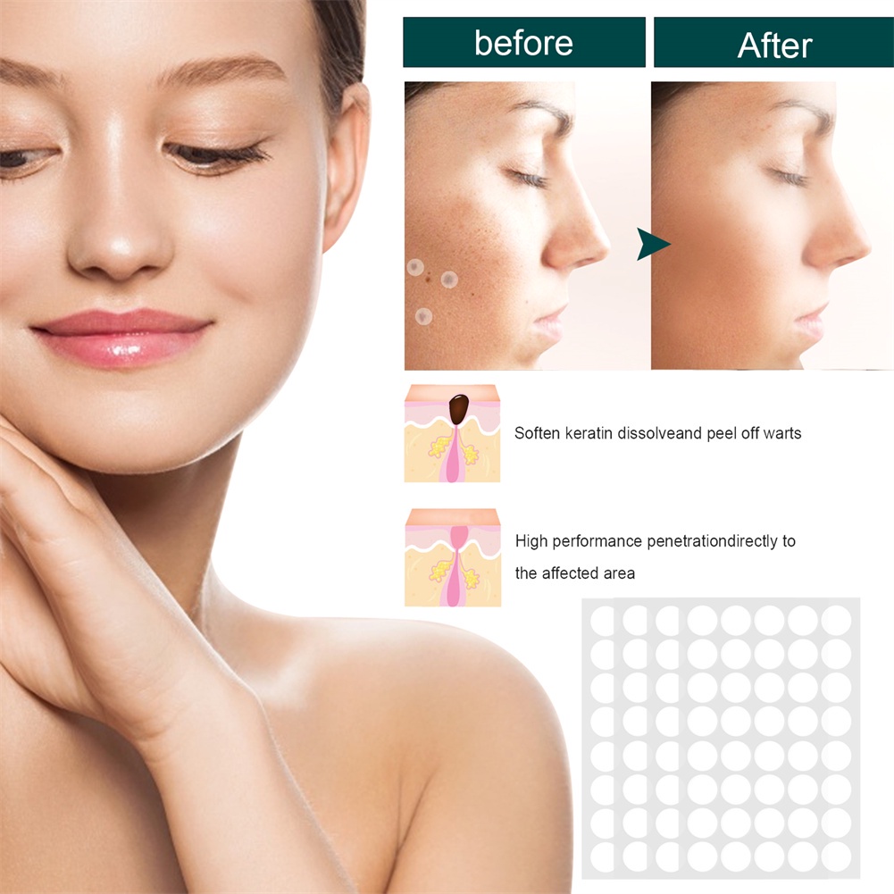julystar-jaysuing-120-pcs-skin-tags-patches-กำจัดปลอดภัยไม่เจ็บปวด-acne-wart-removal-patches-ชุดดูแลผิว-antibacterial-patch-natural-gentle-บรรเทาอาการปวด