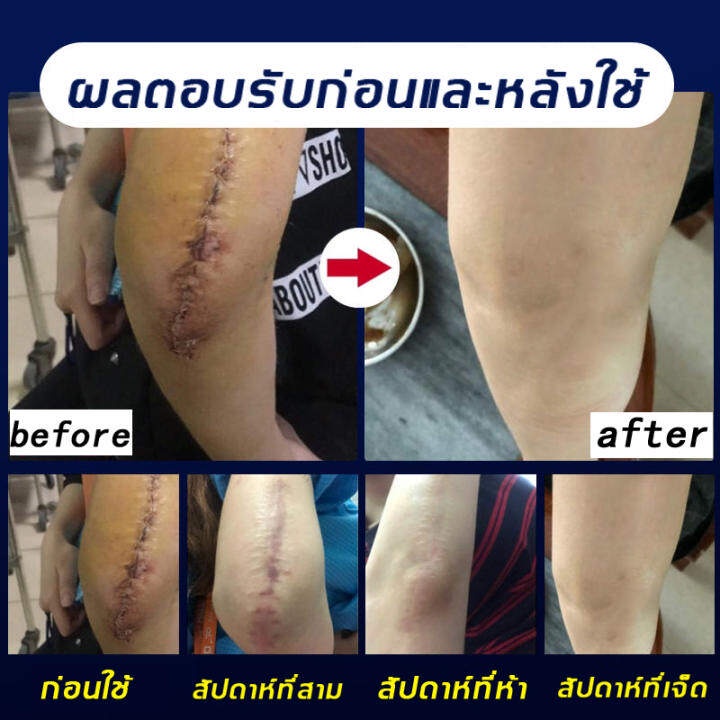 เตรียมจัดส่ง-eelhoe-กรีมรักษารอยแผลเป็น-ครีมลดรอยแผลเป็น-30ml-รอยแผลเป็นจางลงอย่างมีประสิทธิภาพ-ครีมลดแผลเป็น-ครีมทาขาลายจุด-ครีมรักษารอยดำ-ครีมลบแผลเป็น-ครีมรักษาแผลเป็น-ครีมลดรอยแผลไฟไหม้-น้ำร้อนลวก