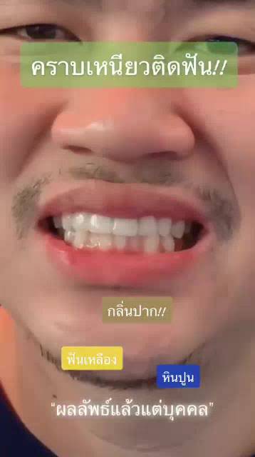 1แถม1-รางฟอก-ส่งฟรี-ไม่ต้องใช้โค้ด-เจลฟอกฟันขาว-ยาสีฟันฟอกฟันขาว-dental-switz-ฟันขาวฟอกเองที่บ้าน