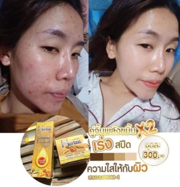 ครีมรักษาสิว-ขมิ้นแท้100-herbal-บอกลาหน้าสิว-แก้ปัญหาคนมีสิวโดยเฉพาะ-ของแท้-มี-อย