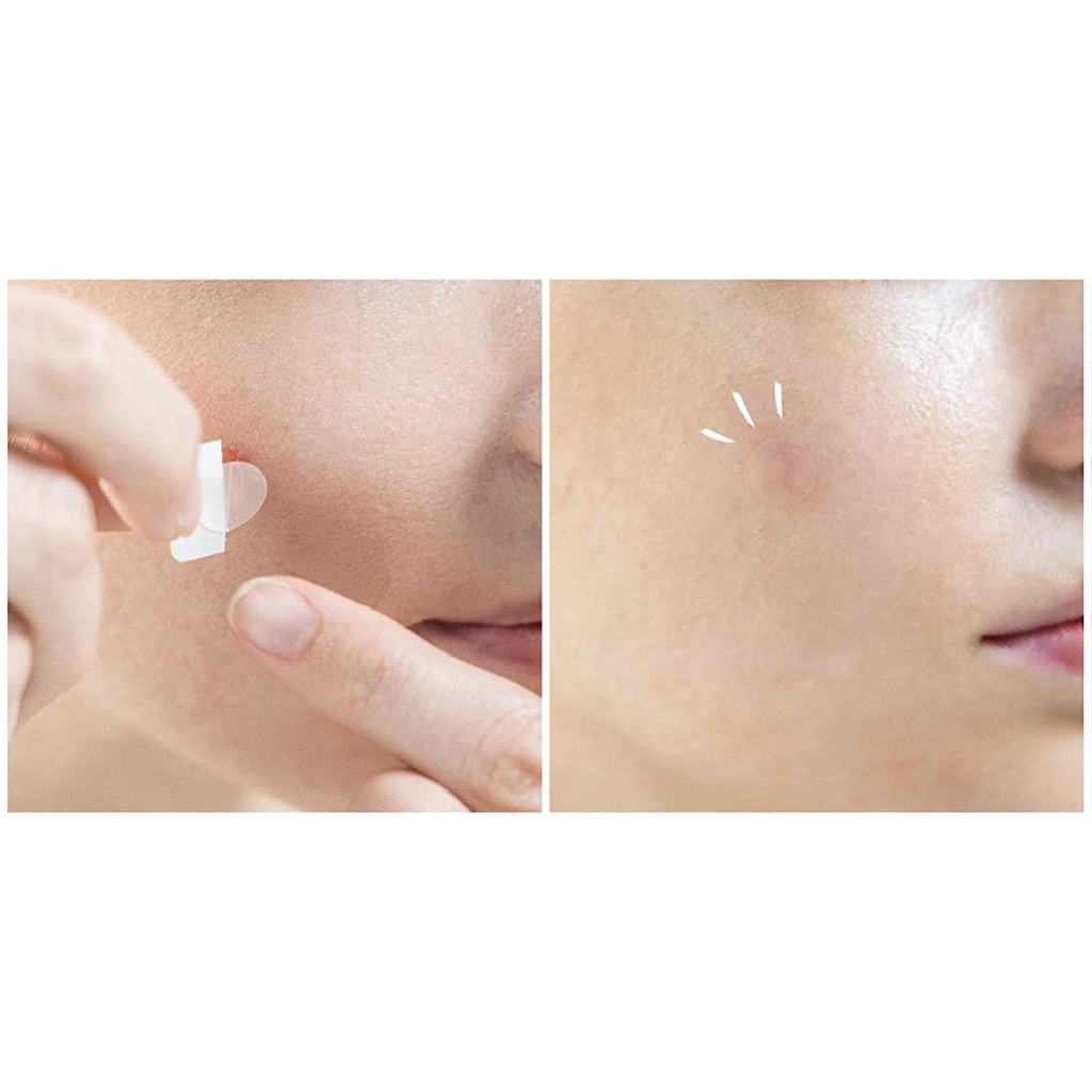 memuzsr-ลดเพิ่มทันที-45-dermaangel-แผ่นแปะสิวเดอร์มาแองเจิลสำหรับกลางคืน-12-ชิ้น
