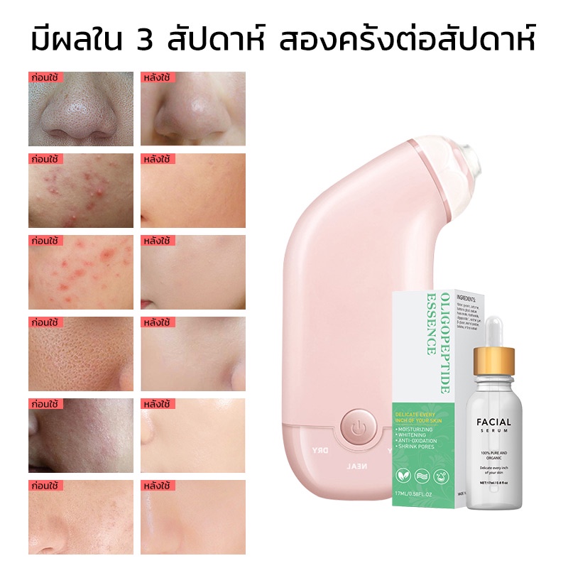 amazefan-เครื่องดูดสิว-เครื่องดูดสิวเสี้ยน-ที่ดูดสิวเสี้ยน-กำจัดสิวหัวดำ-สิว-ผิวหน้า-ดูดสิวเสี้ยนอุดตัน-หัวดำ-remover