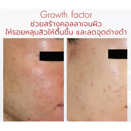 growth-factor-total-age-lift-essence-10-g-เอสเซนต์-สูตรเข้มข้น-ฟื้นฟูสภาพผิวหน้า-เติมเต็มร่องลึก-ลด-ริ้วรอย-บนใบหน้า