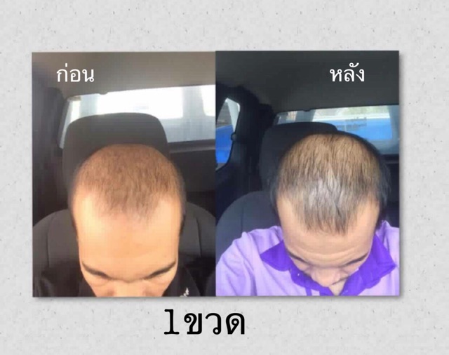 ภาพสินค้าCleara *ลดเพิ่ม100 ทักแชท* เคลียร่า เซรั่ม สเปรย์ แชมพู : ปลูกผม ลดการหลุดร่วง ช่วยให้รากผมใหม่แข็งแรง ไม่หลุดร่วงง่าย จากร้าน atmyroom บน Shopee ภาพที่ 7