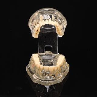 Dental Implantation Model Study Teeth Bridge Disease Restoration Teaching Teaching