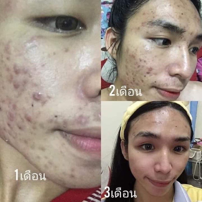 9-9-แถมสบู่-ชุดขายดี-ฝ้า-หน้าใส-1-240-ของแถมมีจำนวนจำกัด