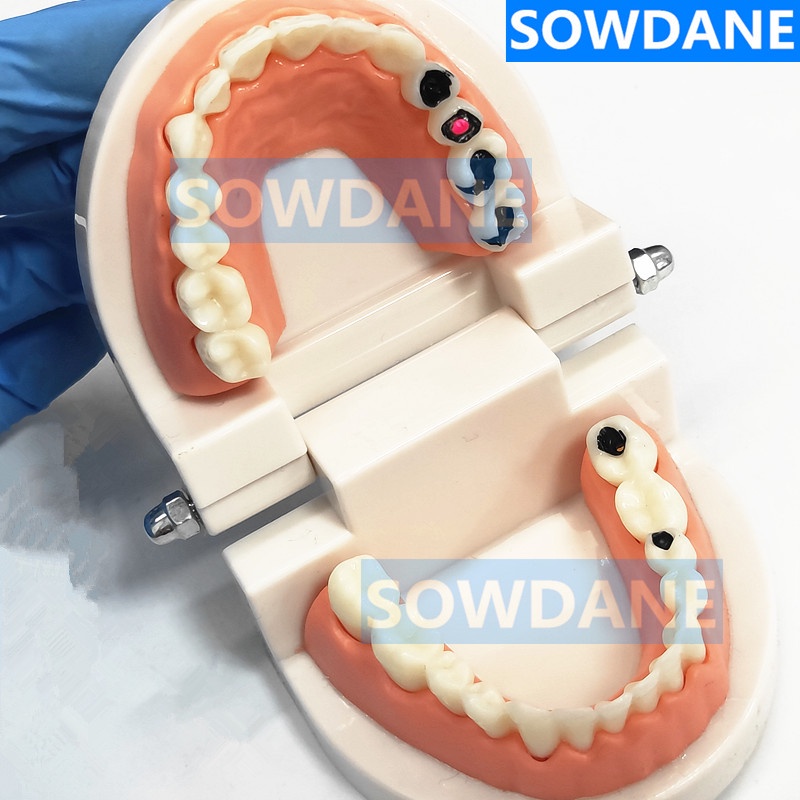 dental-tooth-model-teeth-model-dental-caries-model-for-patient-communication-dentist-study-model-with-decayed-tooth