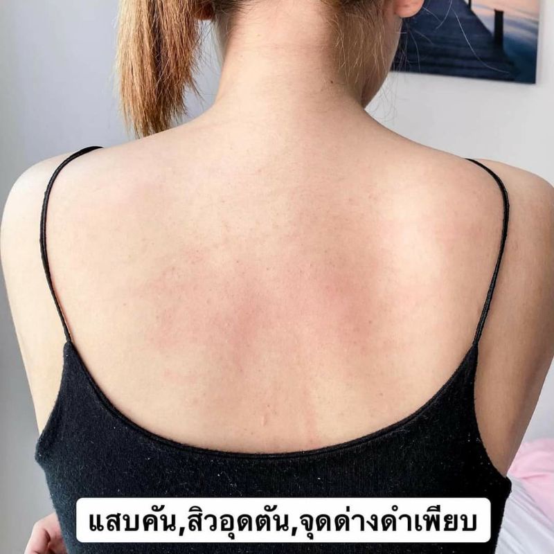 สเปรย์ฉีดสิว-มิสทีน-สิวบริเวณแผ่นหลัง-หน้าอก-หรือลำตัวหายเกลี้ยง-รอยสิวจางลง-แผ่นหลังเรียบเนียนขึ้น-ใส่ชุดไหนก็มั่นใจ