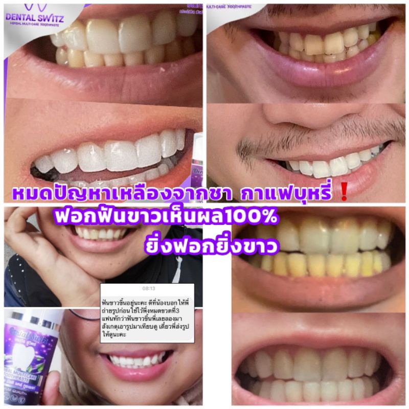 1แถม1-รางฟอก-ส่งฟรี-มีปลายทาง-ไม่ต้องใช้โค้ด-เจลฟอกฟันขาว-ยาสีฟันฟอกฟันขาว-dental-switz-ฟันขาวฟอกเองที่บ้าน