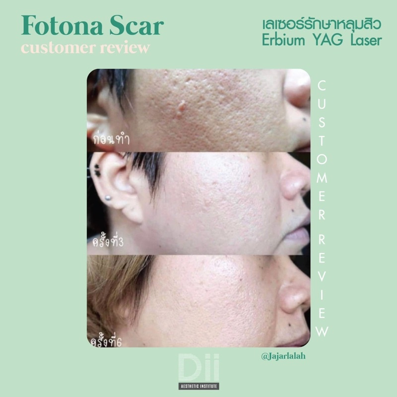 ภาพหน้าปกสินค้าDii Aesthetic : Fotona Acne Scar 1 Time จากร้าน dii_aesthetic บน Shopee