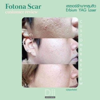 ภาพขนาดย่อของภาพหน้าปกสินค้าDii Aesthetic : Fotona Acne Scar 1 Time จากร้าน dii_aesthetic บน Shopee