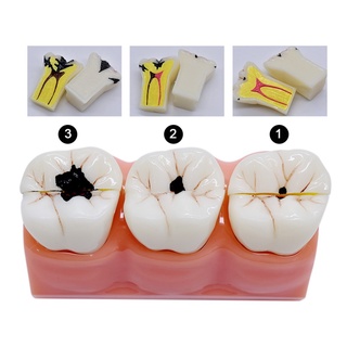 【ddydental】โมเดลทันตกรรม Caries Evolution ของเล่นสําหรับเด็ก