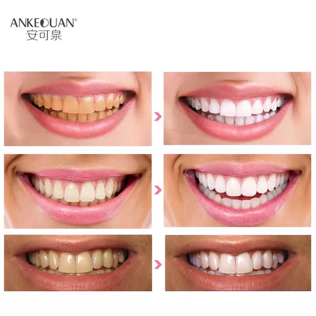 7คู่-แผ่นฟอกฟันขาว-เจลฟอกฟันขาว-3d-whitening-gel-strips-bright-white-dental-treatment